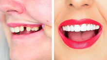 Load image into Gallery viewer, Instant Perfect Smile Upper & Lower Clip/Snap On Veneers for Perfect Teeth