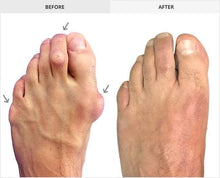 Load image into Gallery viewer, Three-Arch Silicone Hammer Toe / Bunion Corrector