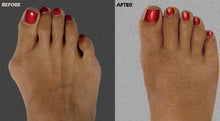 Load image into Gallery viewer, Three-Arch Silicone Hammer Toe / Bunion Corrector