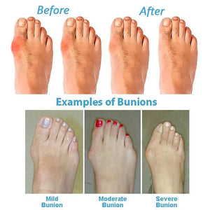 Bunion-Correcting Comfort Platform Sandals